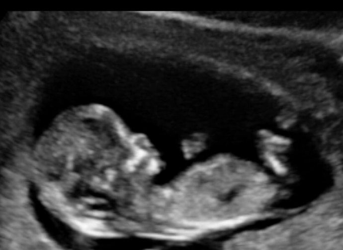 Obbligo di ascoltare il battito del feto: la petizione