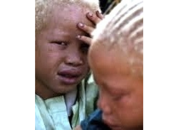 Bambini africani albini 