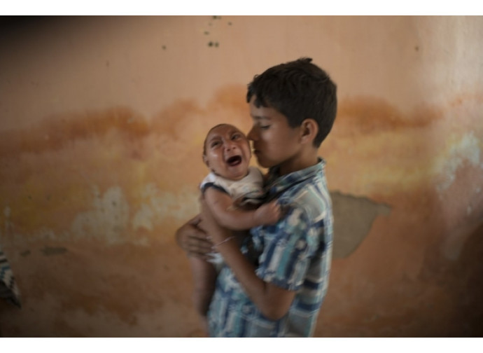 Brasile, un bambino affetto da microcefalia
